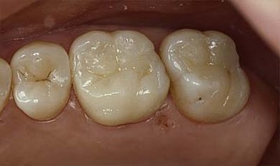 Keramikinlays im Zahn eingesetzt Keramikinlays im Zahn eingesetzt - Dr. Carsten Falcke