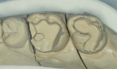 Keramikinlays im Gipsmodell / bearbeiteter Zahn bearbeiteter Zahn - Dr. Carsten Falcke